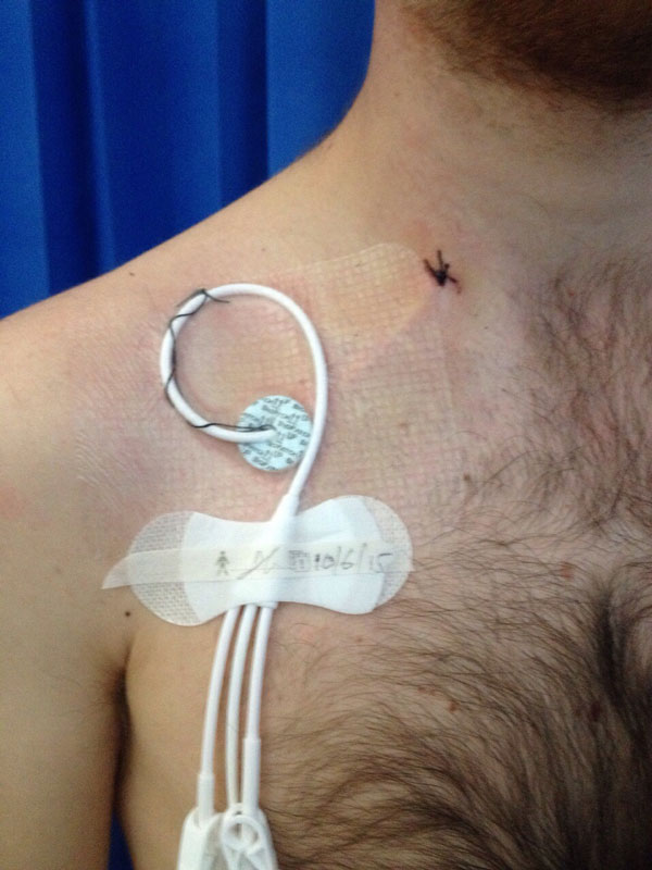 Hickman Line Removal