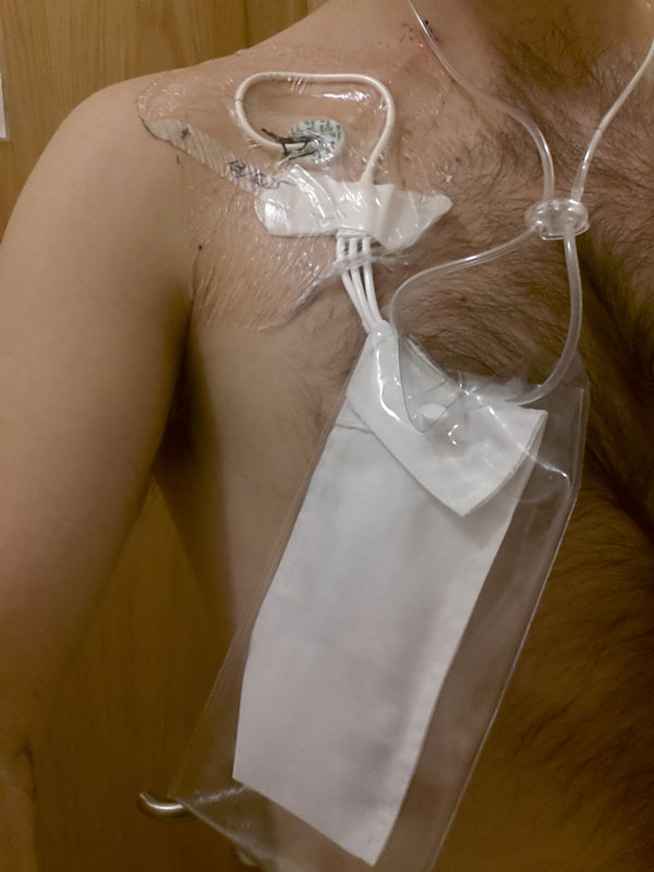 Having a Hickman line what's it like? Anthony Nolan